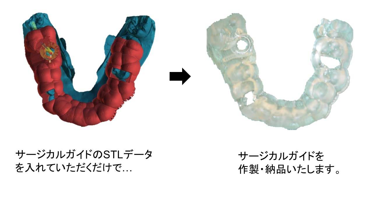 サージカルガイド（メタルスリーブなし）