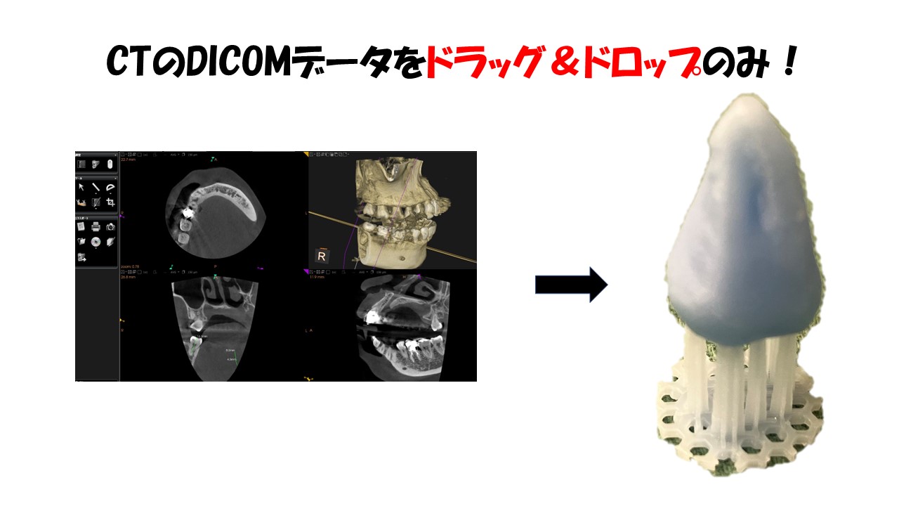 歯牙レプリカ（DICOM受け）